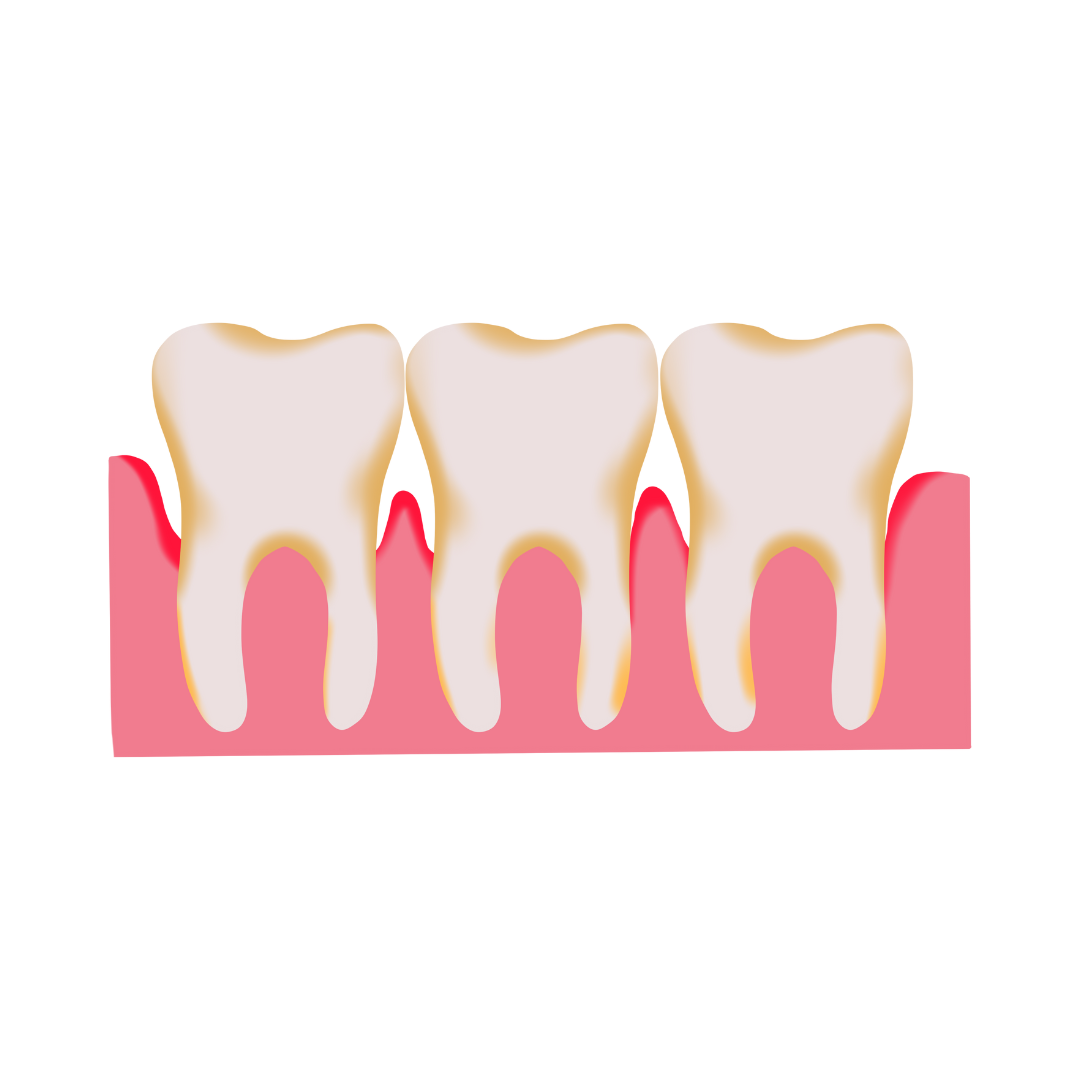 Tratamento da doença periodontal